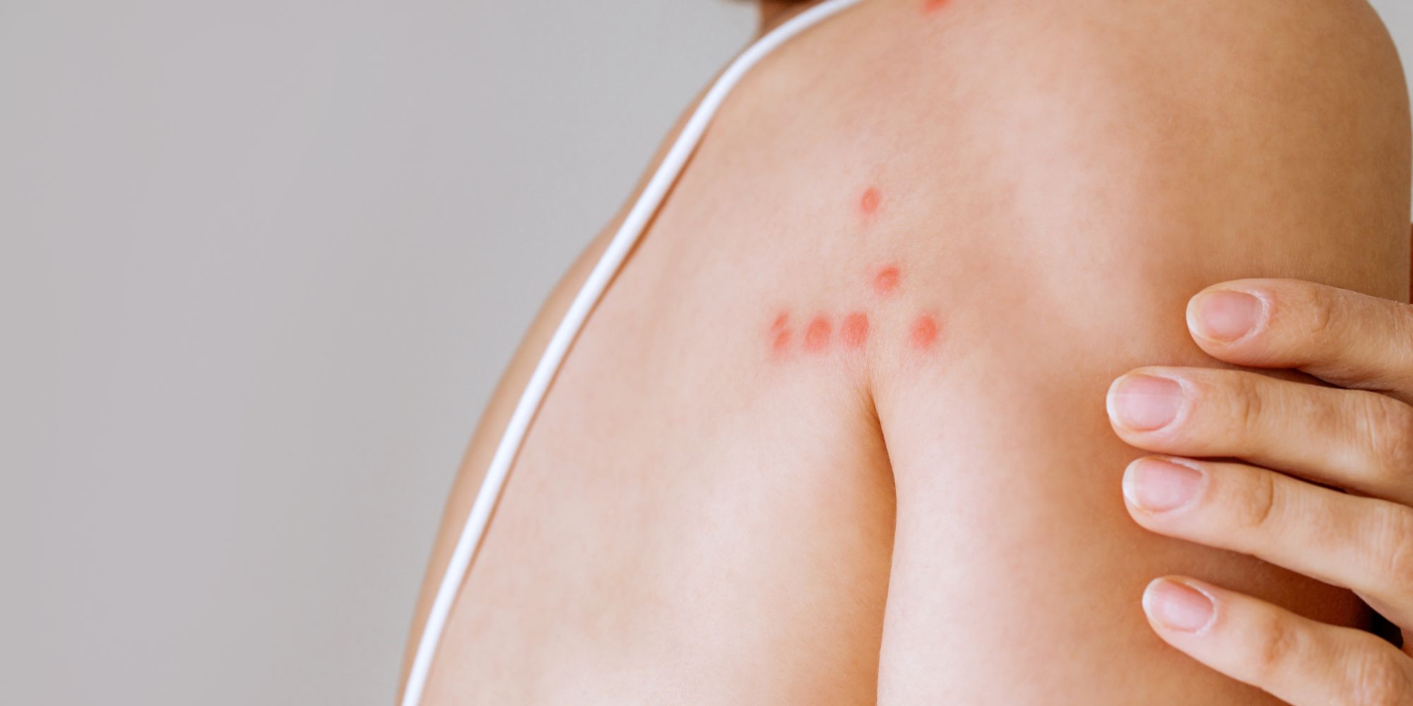 Piqûres rouges en ligne sur l’épaule d’une femme – exemple typique pour illustrer les différences entre piqûres de puces et punaises de lit