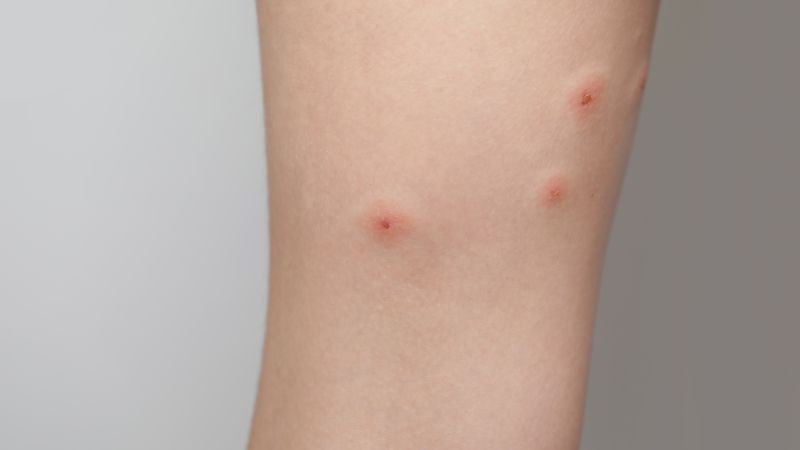 Piqûres rouges isolées sur un bras – pour reconnaître une piqûre de punaise de lit ou de puce
